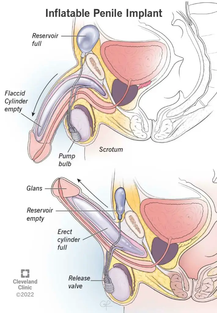 10054 penile implants