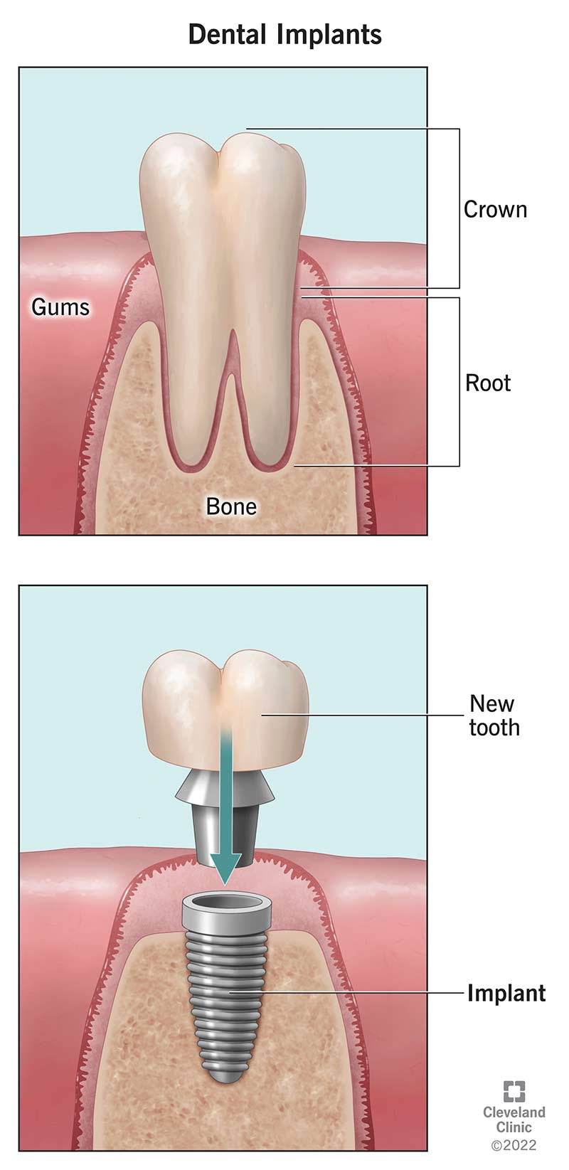 Dabīgais zobs pret zobu implantu žokļa kaulā.