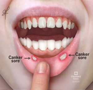 10945 canker sores