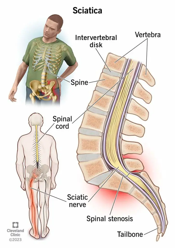 12792 sciatica