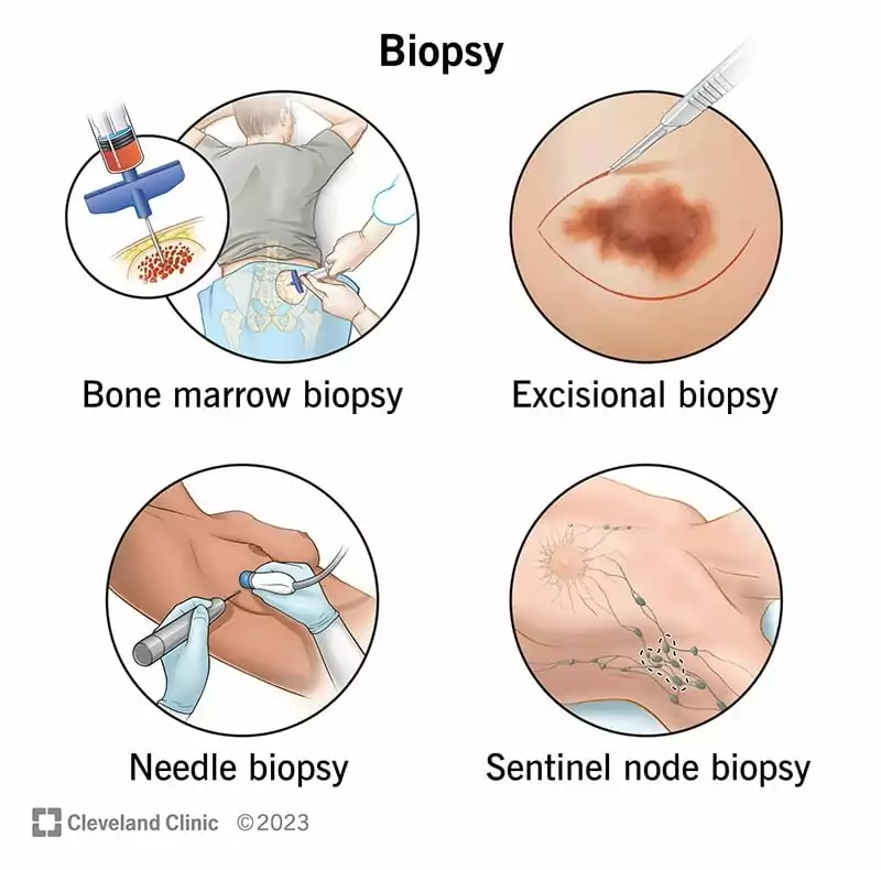 15458 biopsy