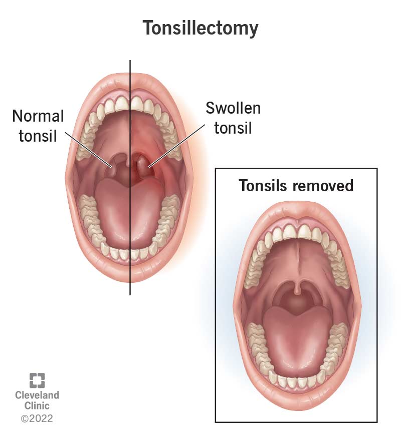 15605 tonsillectomy