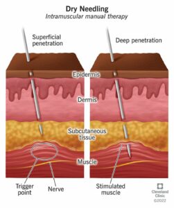 16542 dry needling