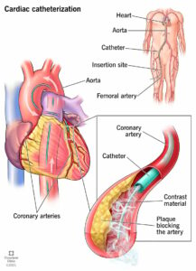 16832 cardiac catheterization