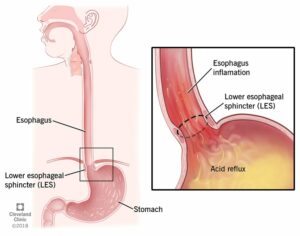 17019 gerd chronic acid reflux