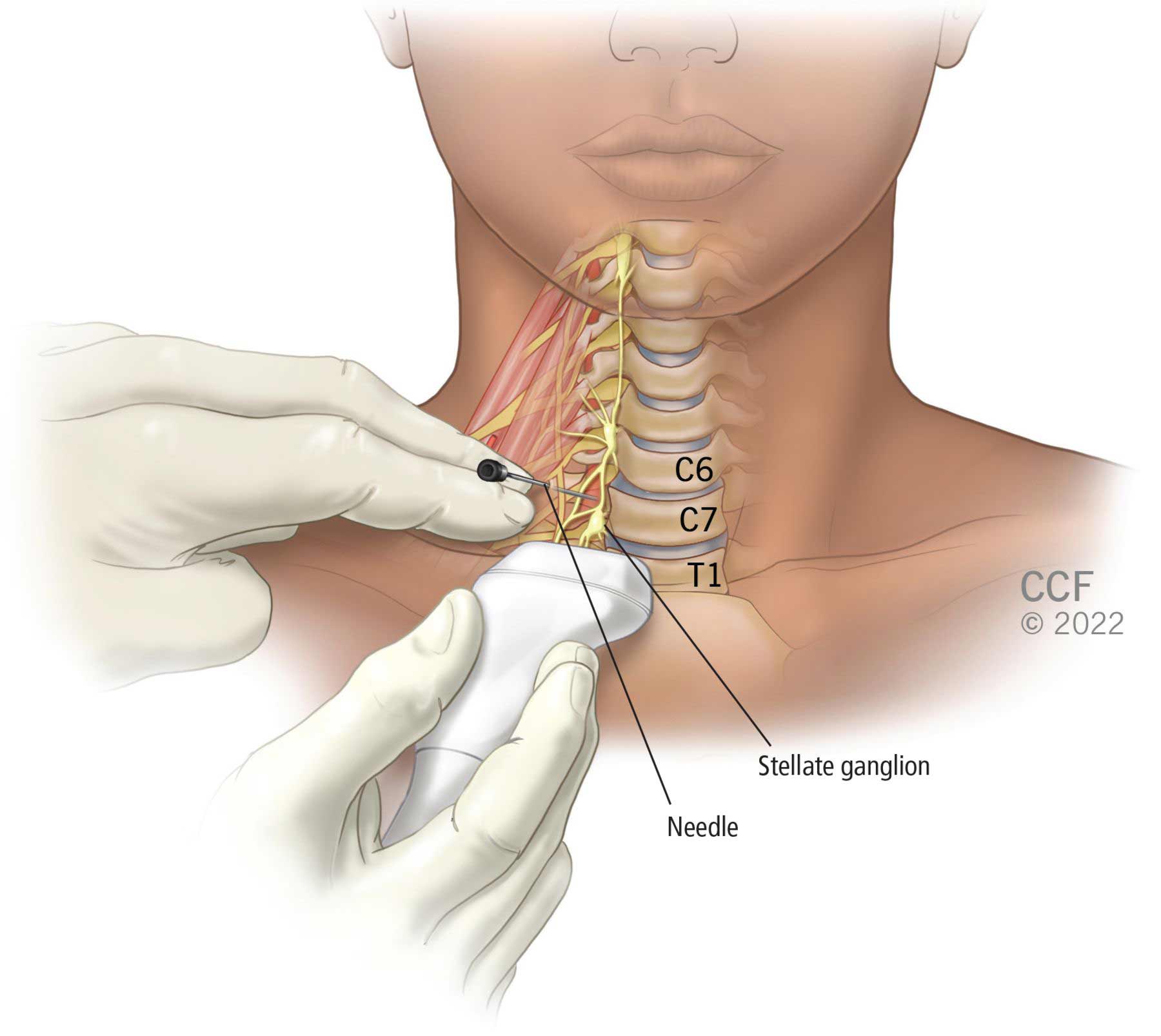 Zvaigžņu ganglija anatomiskā atrašanās vieta atrodas kakla priekšpusē blakus C7 un T1 skriemeļiem.