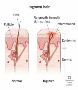 17722 ingrown hair