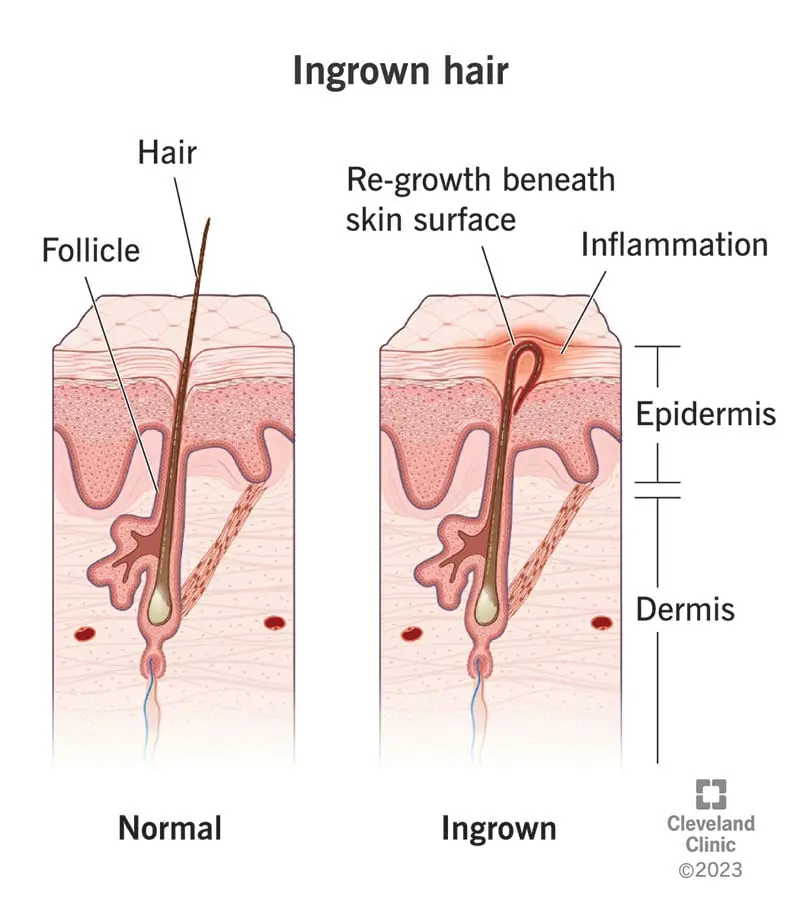 17722 ingrown hair