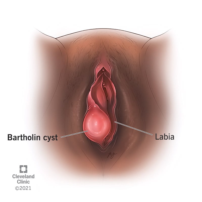 17737 bartholin cyst