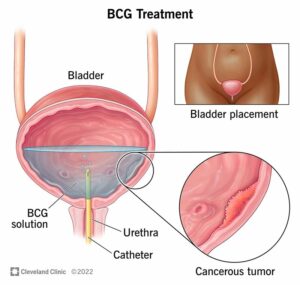 17908 bcg treatment