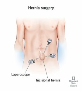 17967 hernia surgery