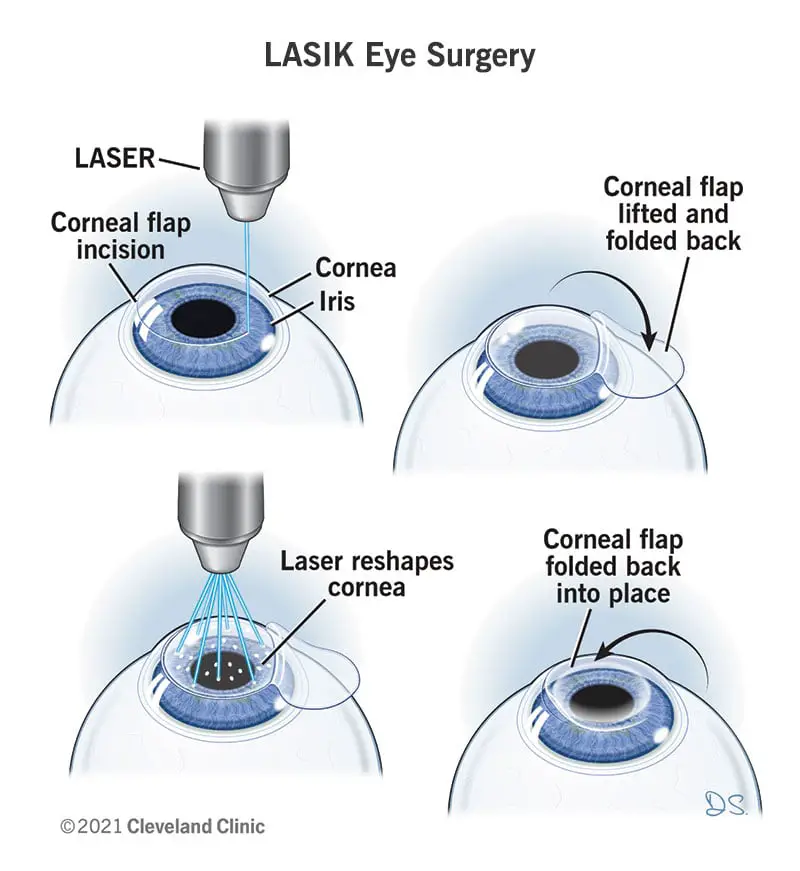 Ilustrācija, kurā parādīti LASIK acu operācijas soļi.