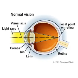 21805 lasik normal vision