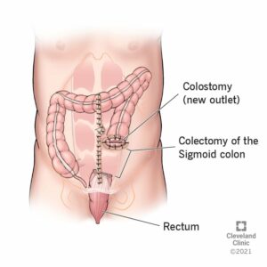 21891 hartmanns procedure illustration final.ashx