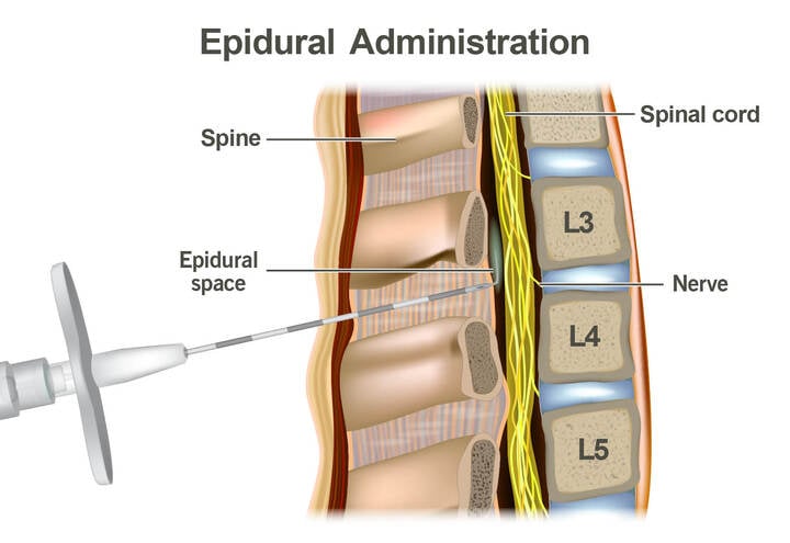 21896 epidural