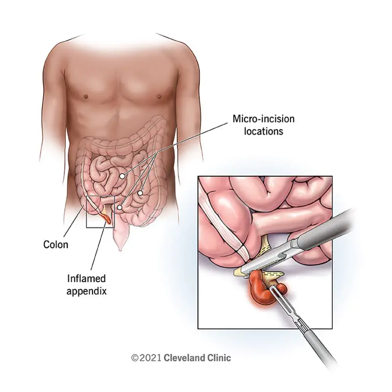 21922 appendectomy