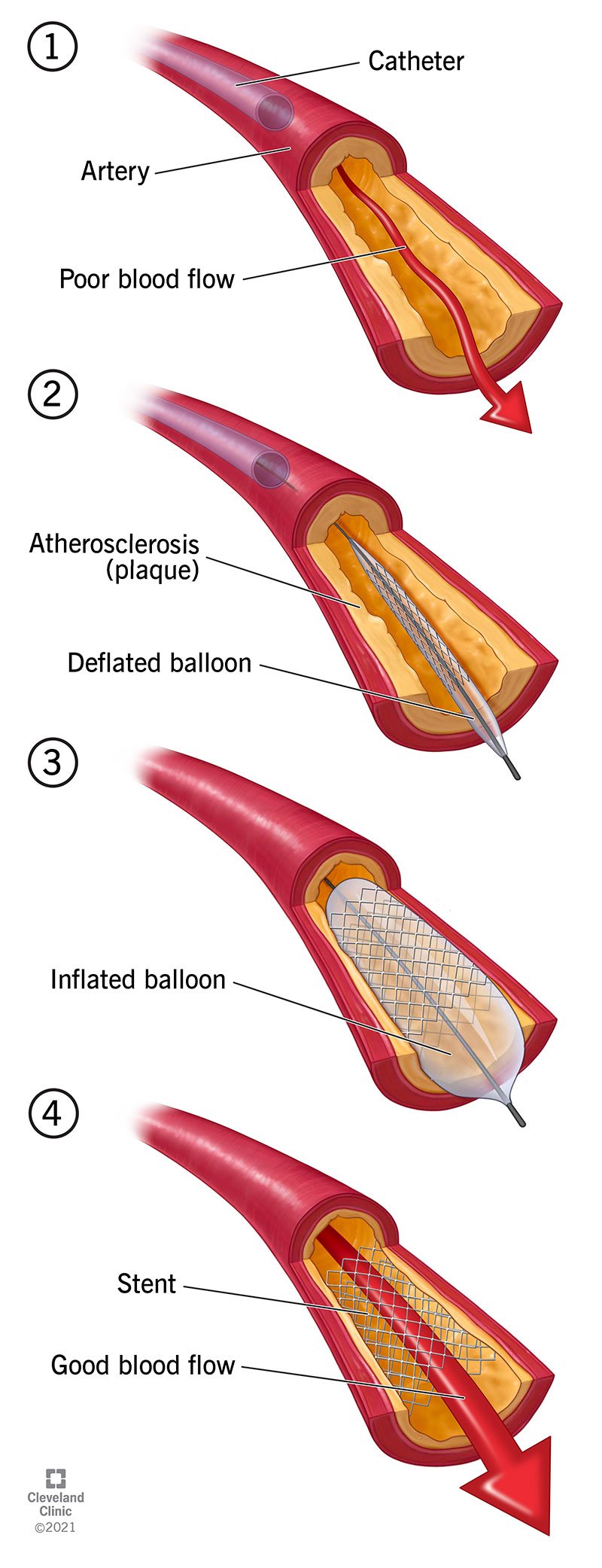 Balons piespiež aplikumu pret jūsu artērijas sienu.