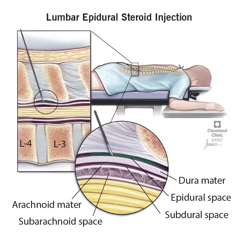 22091 lumbar spine epidural injection final