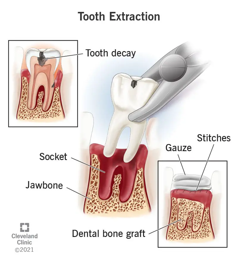 22120 tooth