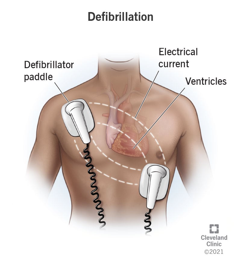 23021 defibrillation