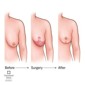 23298 breast lift