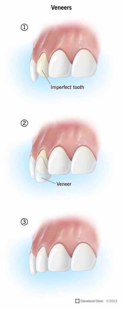 23522 dental veneer