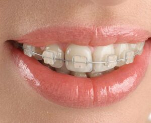 23568 clear braces