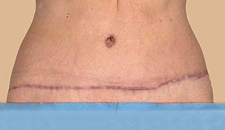 24004 tummy tuck scar