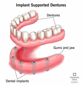 24303 implant supported dentures