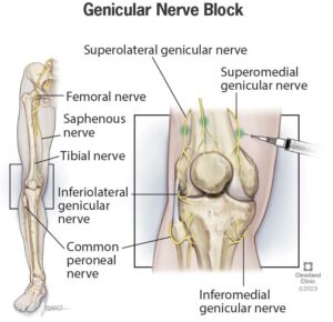 24823 genicular nerve block