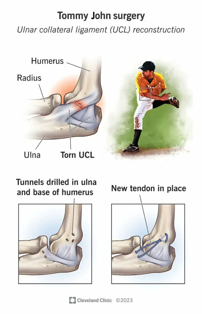 25117 tommy john surgery