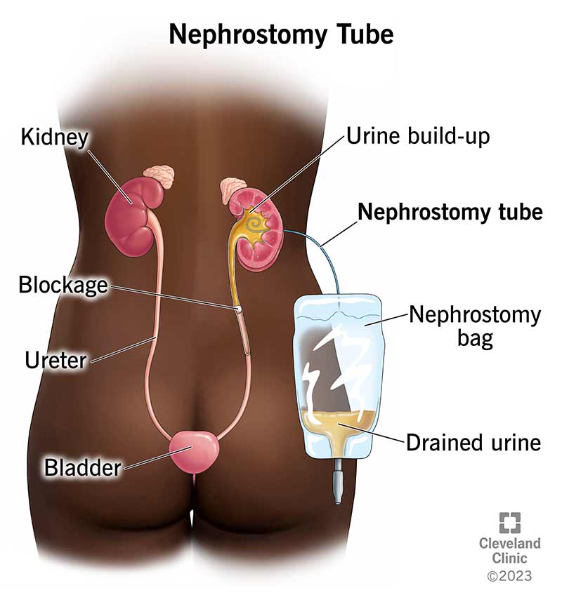 25141 nephrostomy tube