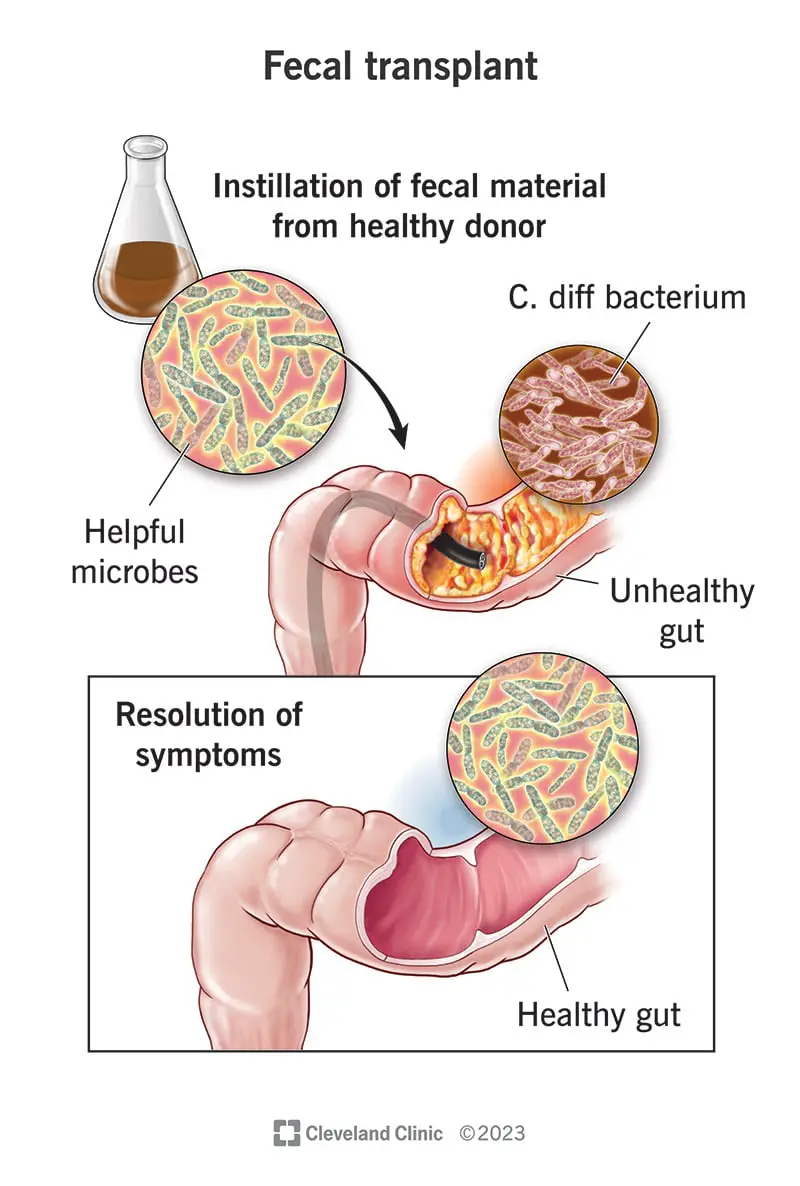 Veicot fekāliju transplantāciju, no veselīgas resnās zarnas ņem nelielu izkārnījumu paraugu un ievieto slimā resnajā zarnā.