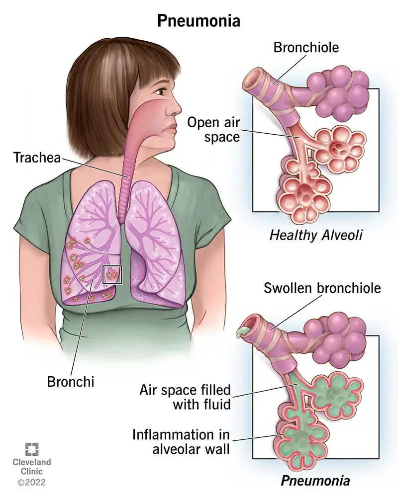 4471 pneumonia 01