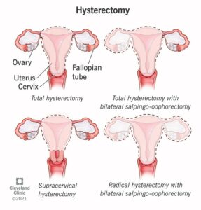 4852 hysterectomy
