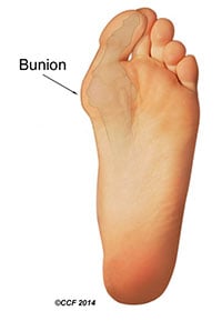 Pēdas ilustrācija: bunion