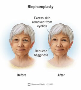 8409 eyelid surgery blepharoplasty