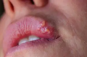 cold Sore Lip 1485050089 770x533 1 650x428