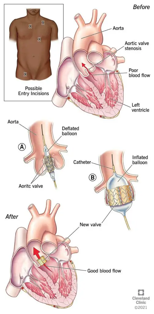 17570 tavr illustration.ashx