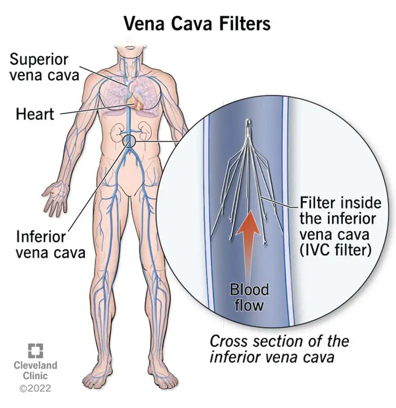 17609 vena cava filters