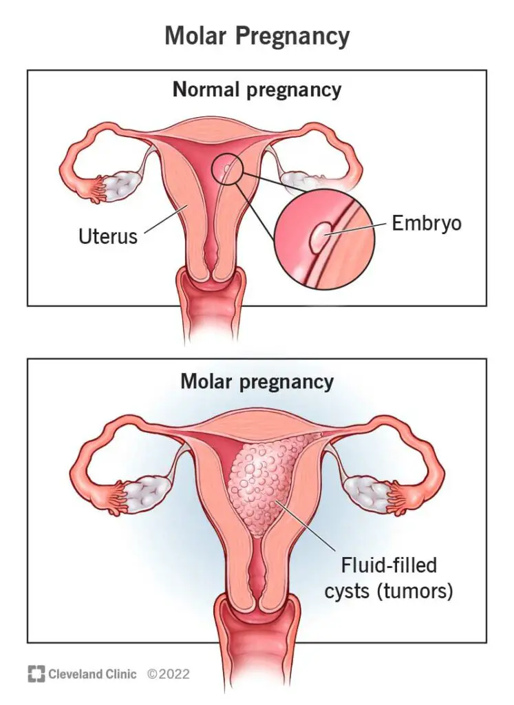 17889 molar pregnancy