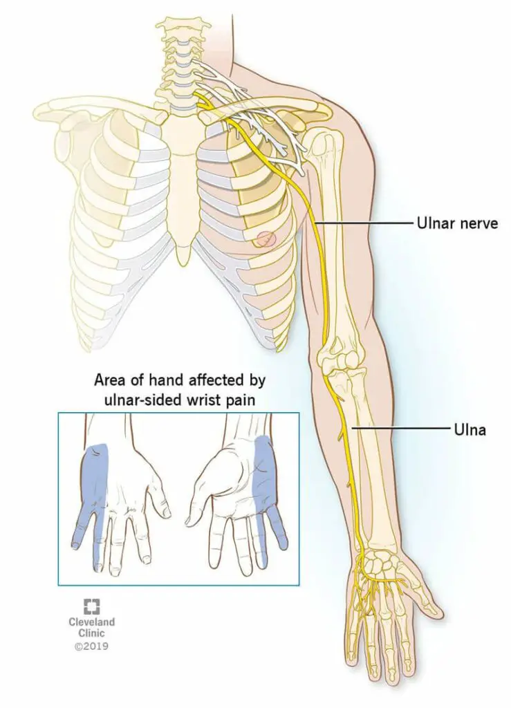 21035 ulnar wrist pain