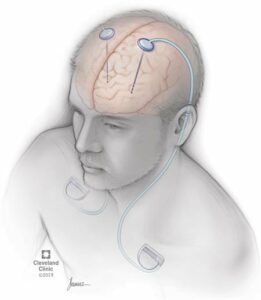 21088 deep brain stimulation