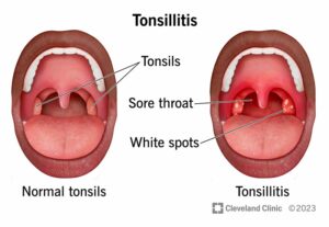 21146 tonsillitis