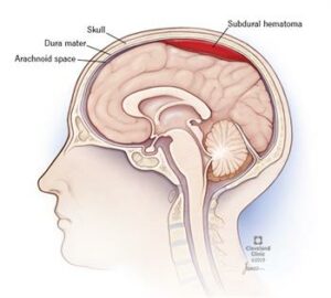 21183 subdural hematoma