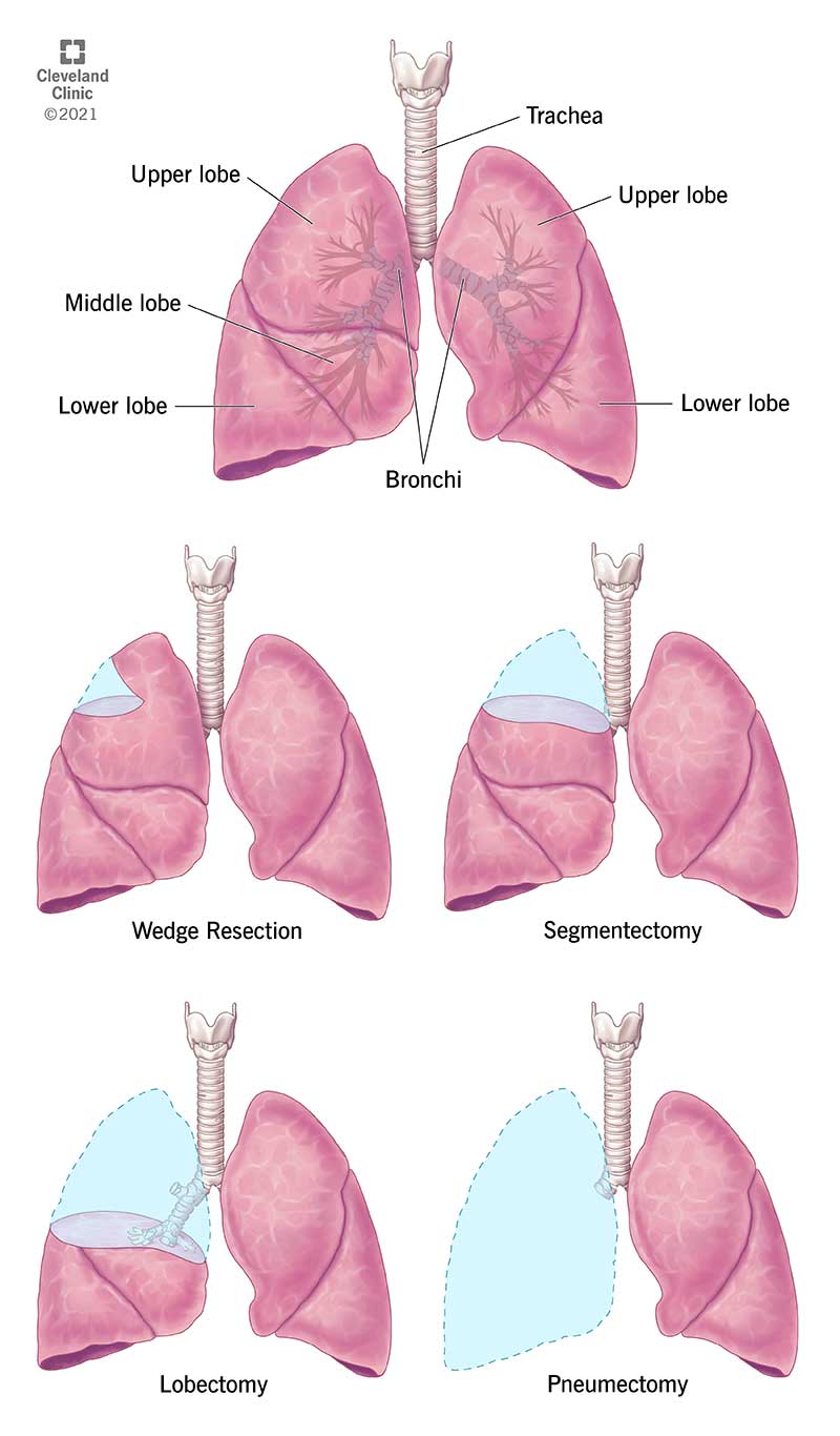 Plaušu diagramma un dažādu veidu plaušu rezekcijas ilustratīvie piemēri.