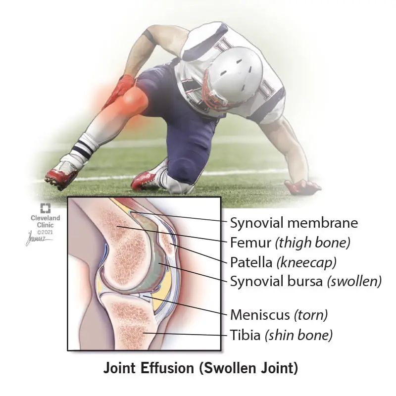 21908 joint effusion knee