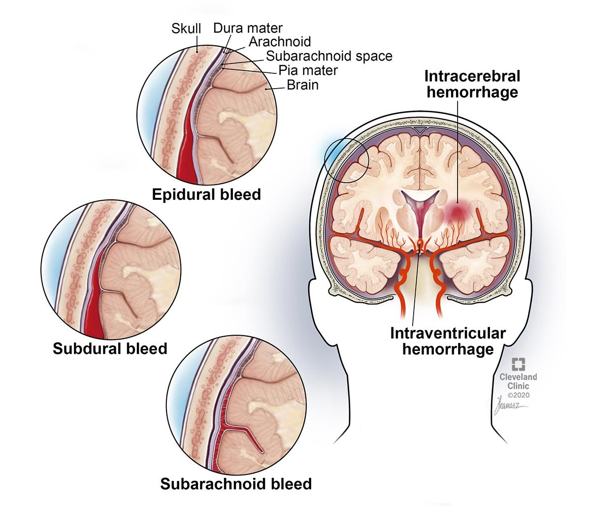 Epidurālā hematoma ir smadzeņu asiņošana starp galvaskausu un membrānu, kas pārklāj jūsu smadzenes.