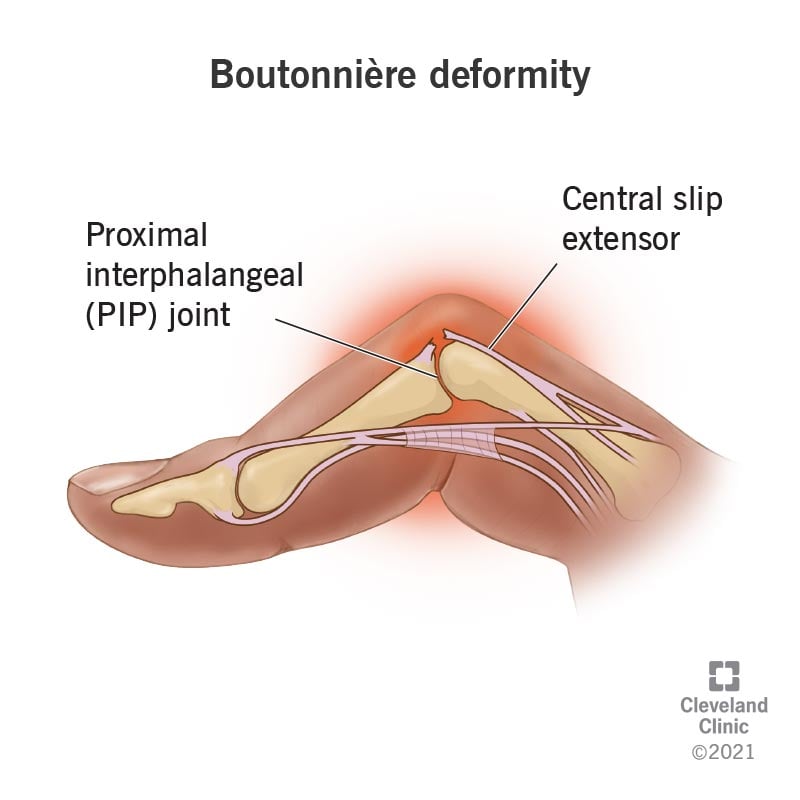 22094 boutonniere deformity