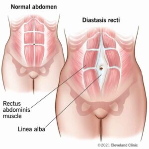 22346 diastasis recti